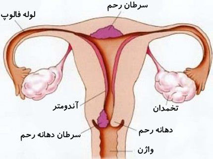 علل و عوارض برداشتن تخمدان زنان